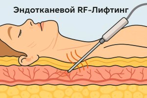 Эндотканевой RF-лифтинг на INNOFILL: безоперационная коррекция фиброза
